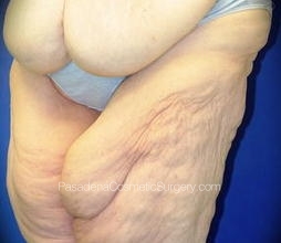 Thighplasty Patient 05 Before
