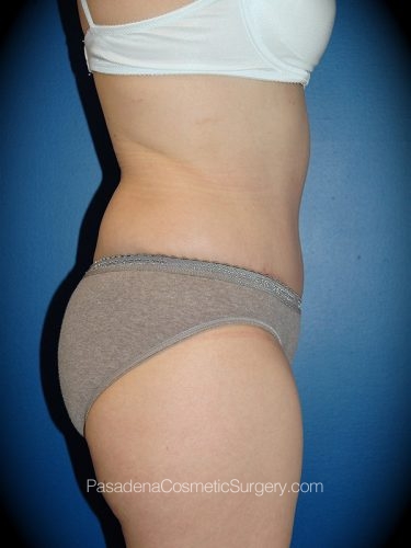 Tummy Tuck Patient 20 After