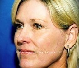 Laser Skin Resurfacing Patient 05 After