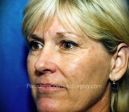 Laser Skin Resurfacing Patient 05 Before