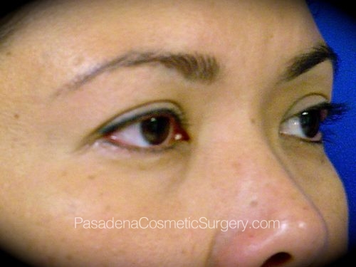 Eyelid Surgery Patient 11 After - 2