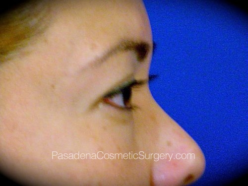 Eyelid Surgery Patient 11 After - 3