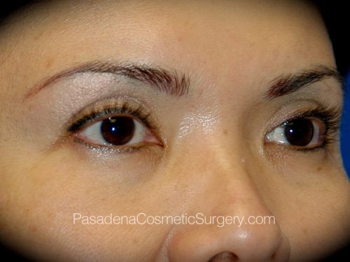 Eyelid Surgery Patient 11 Before - 2