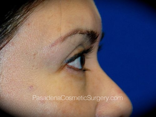 Eyelid Surgery Patient 11 Before - 3