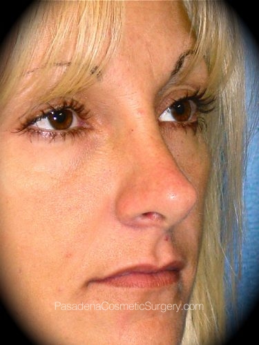 Rhinoplasty Patient 03 After - 2