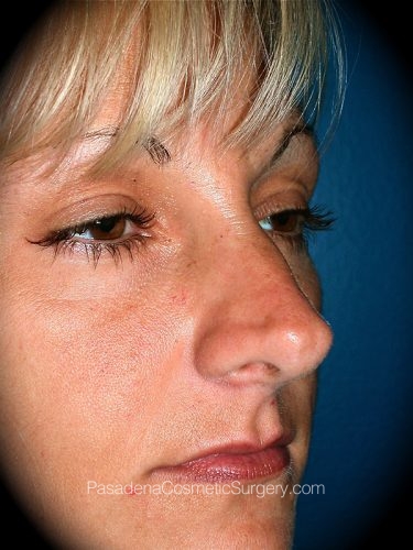 Rhinoplasty Patient 03 Before - 2