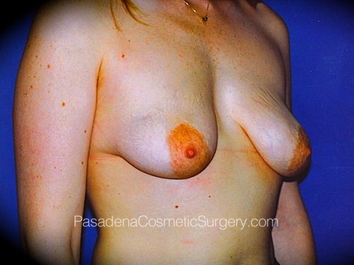 Breast Augmentation with Mastopexy Patient 03 Before - 2