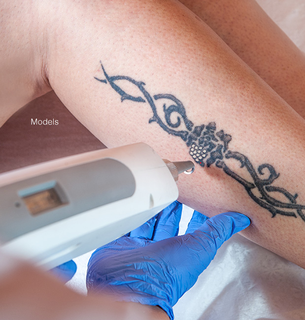 Tattoo removal featured model