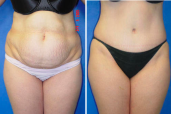 before-and-after-tummy-tuck