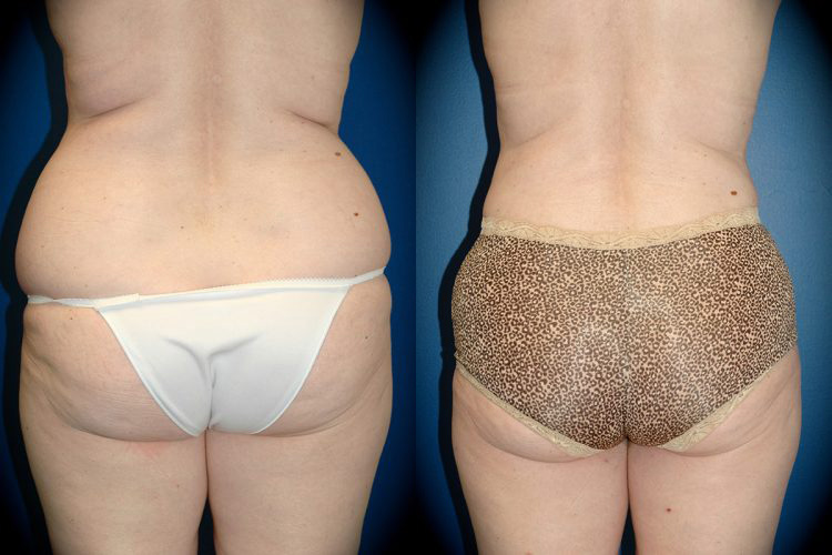 Liposuction in Pasadena, CA Before & After Patient 1