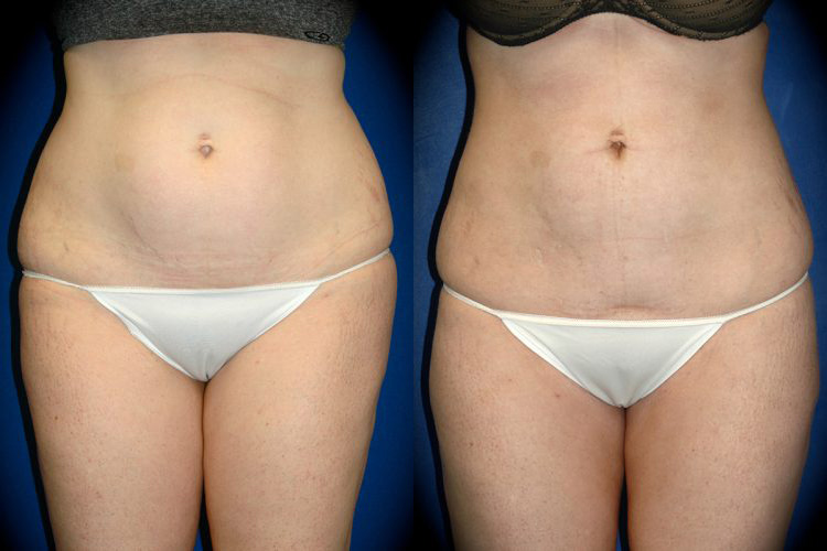 Liposuction in Pasadena, CA Before & After Patient 2