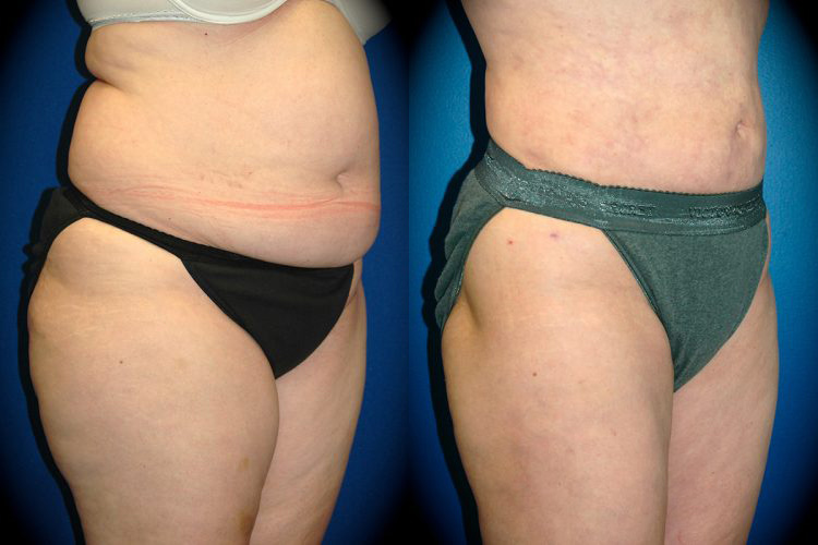 Liposuction in Pasadena, CA Before & After Patient 3