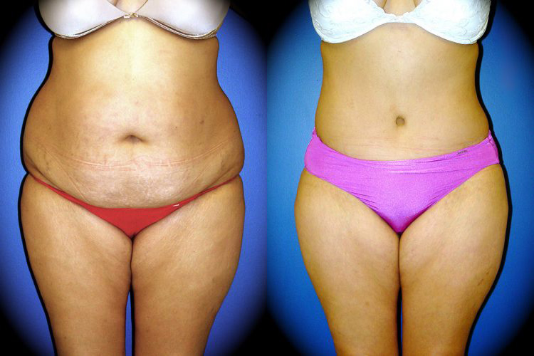 Tummy Tuck in Pasadena, CA Before & After Patient 1