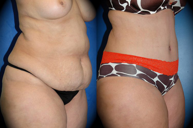 Tummy Tuck in Pasadena, CA Before & After Patient 2