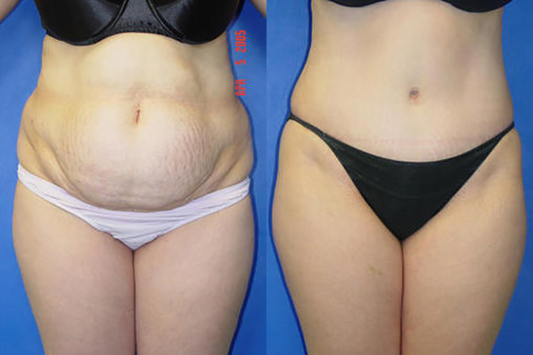 Tummy Tuck Before & After Patient 3