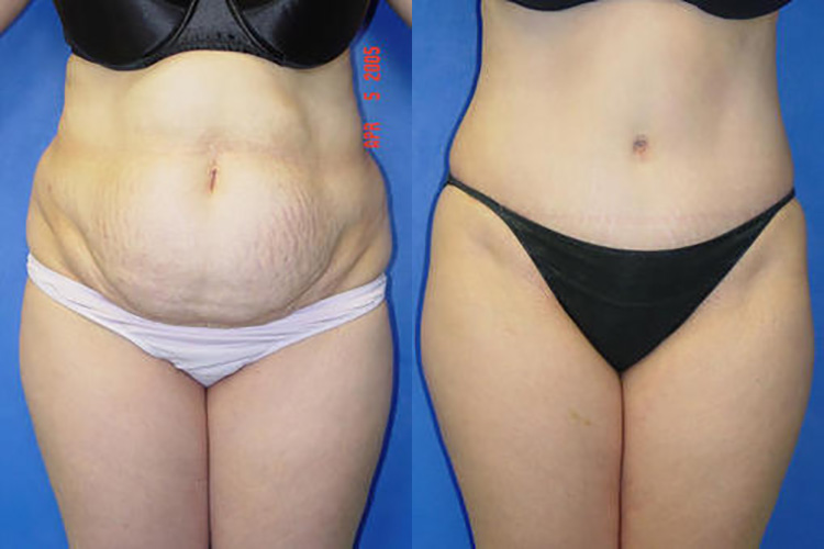 Tummy Tuck in Pasadena, CA Before & After Patient 3