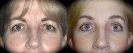 Eyelid Surgery Results