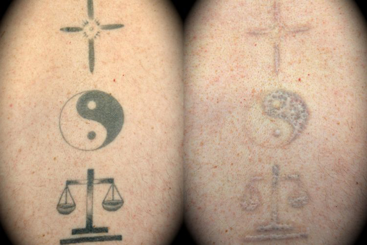 Laser Tattoo Removal Before & After Patient 1