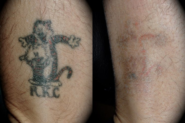Laser Tattoo Removal Before & After Patient 2