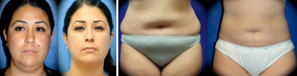 Smartlipo® and Power-Assisted Liposuction Before and After Photos