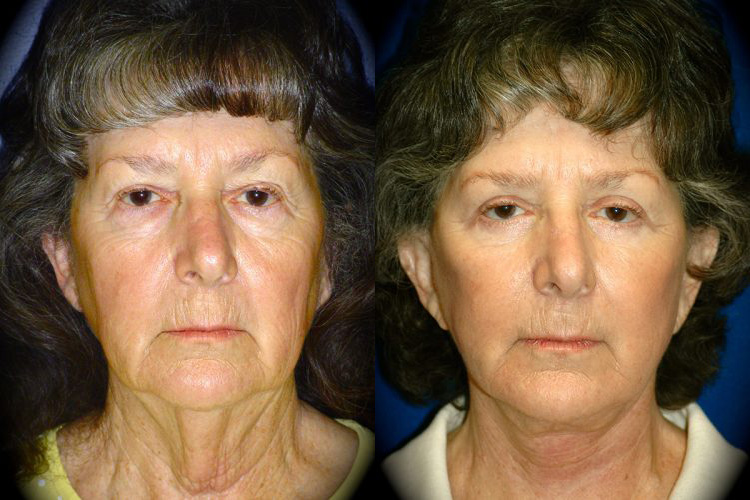 Facelift Before & After Patient 3