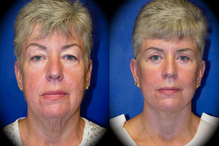 Facelift in Pasadena, CA Before & After Patient 1