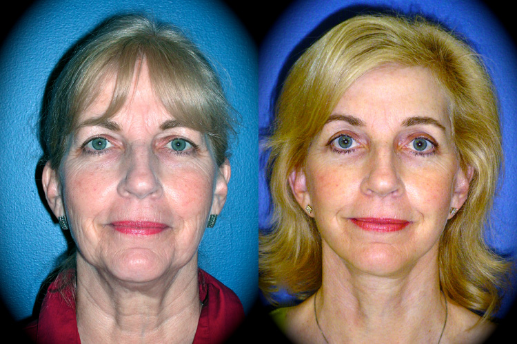 Facelift Before & After Patient 2