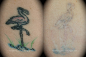 O'Toole Tattoo Removal Patient before and after photos