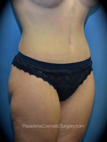 Mommy Makeover Patient 01 After - 2