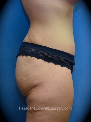 Mommy Makeover Patient 01 After - 3