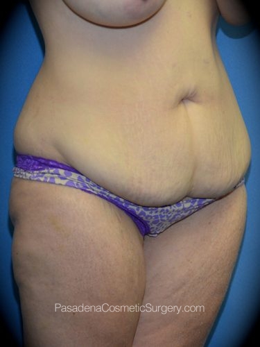 Mommy Makeover Patient 01 Before - 2