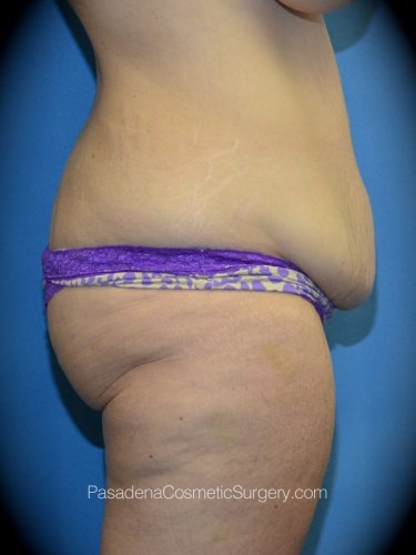 Mommy Makeover Patient 01 Before - 3