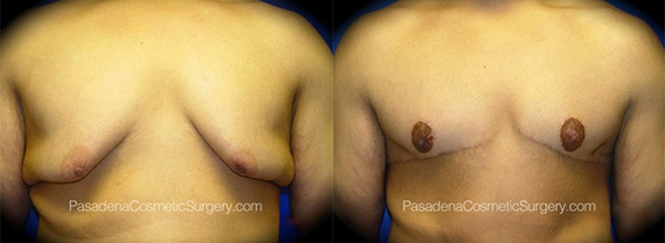 Gynecomastia in Pasadena, CA Before & After Patient 1