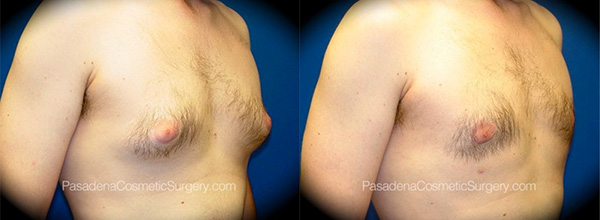 Gynecomastia in Pasadena, CA Before & After Patient 2