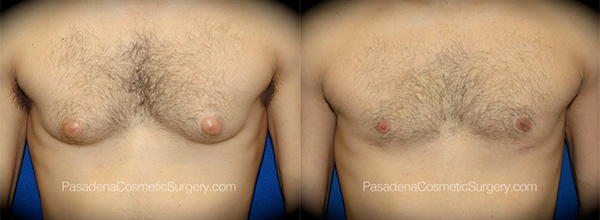 Gynecomastia in Pasadena, CA Before & After Patient 3