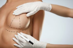 Woman's breast marked with marker by surgeon in preparation for surgery