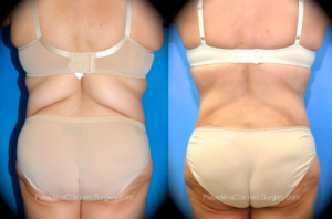 SmartLipo Patient by Dr. OToole