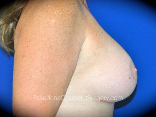 Breast Augmentation with Mastopexy Patient 16 After - 3