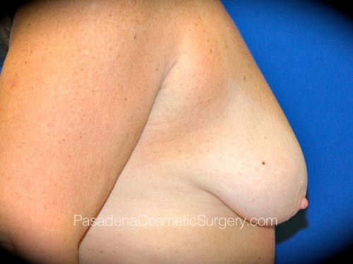 Breast Augmentation with Mastopexy Patient 16 Before - 3