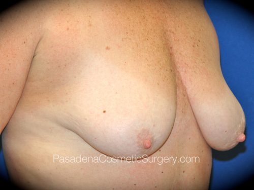 Breast Augmentation with Mastopexy Patient 16 Before - 2