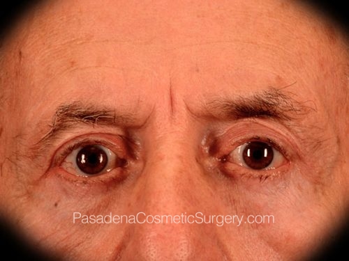 Eyelid Surgery Patient 28 After