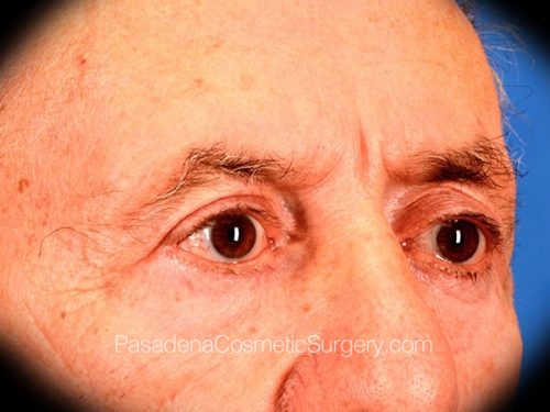 Eyelid Surgery Patient 28 After - 2
