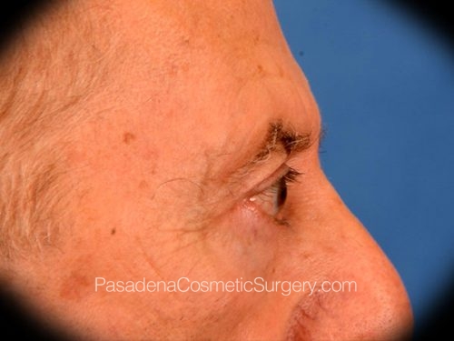 Eyelid Surgery Patient 28 After - 3