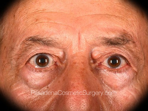 Eyelid Surgery Patient 28 Before