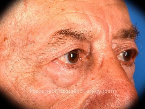 Eyelid Surgery Patient 28 Before - 2