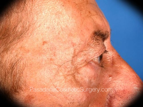 Eyelid Surgery Patient 28 Before - 3