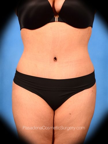 Tummy Tuck Patient 22 After