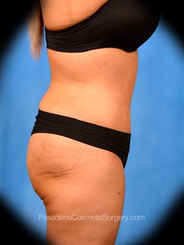 Tummy Tuck Patient 22 After - 3