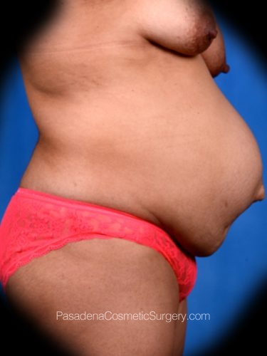 Tummy Tuck Patient 23 Before - 2