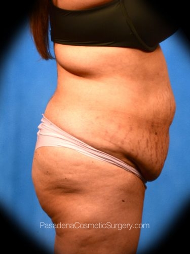 Tummy Tuck Patient 22 Before - 3